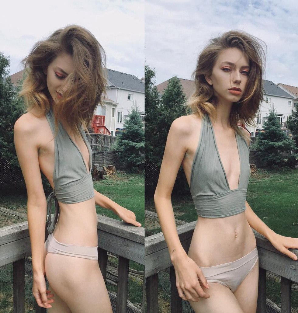 Anna Zholobova anorexia