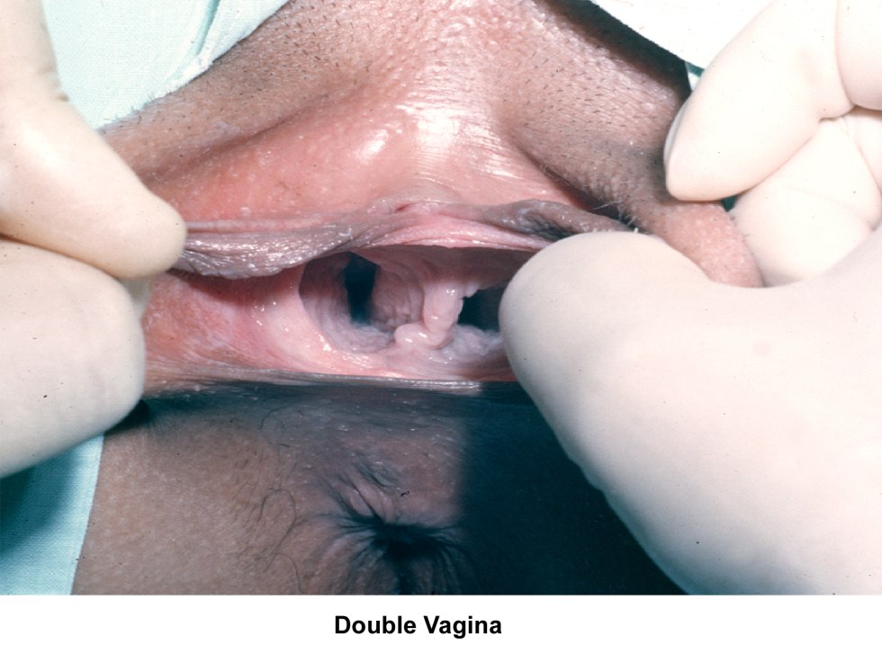 Women with several vagina