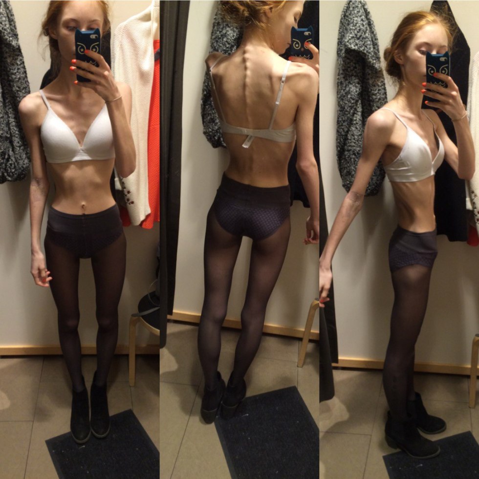 Anorexica in underwear