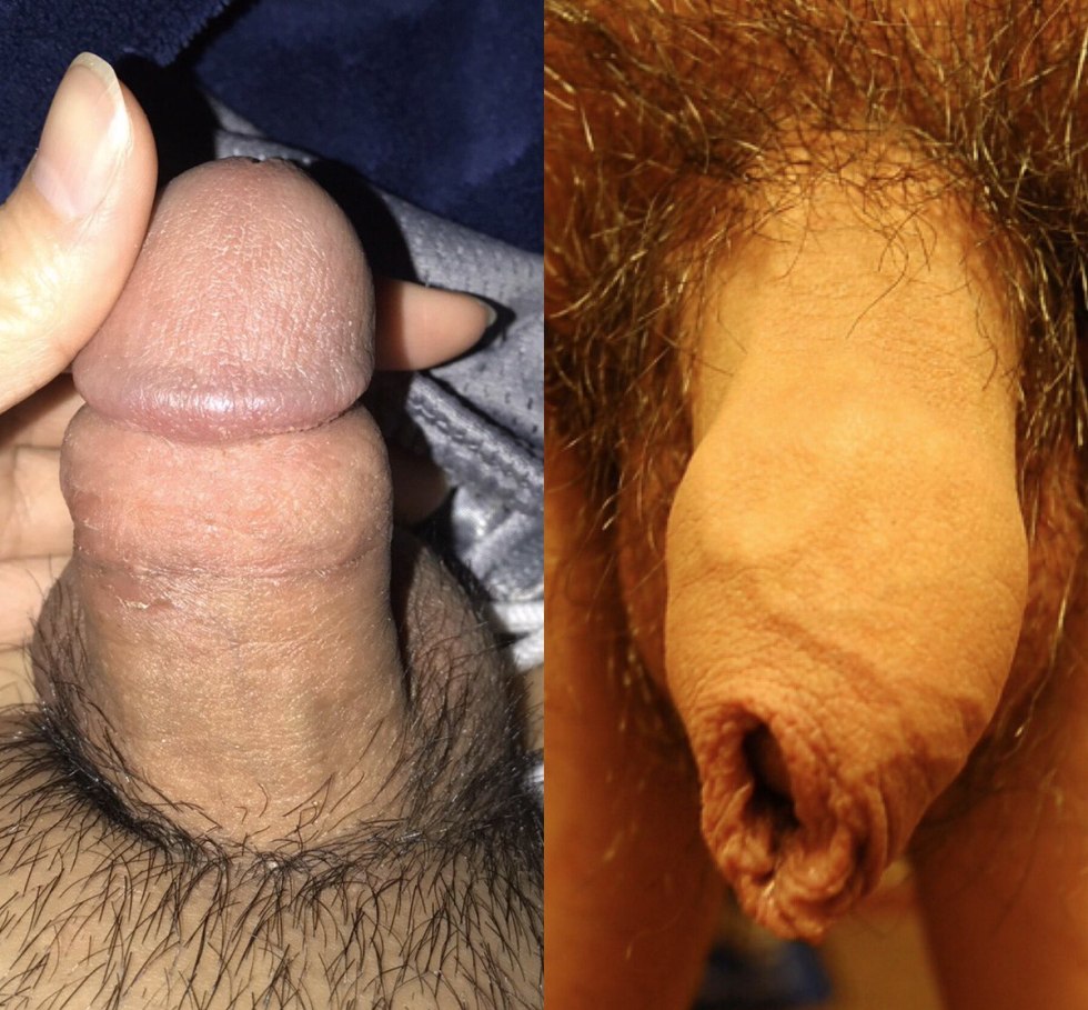 Swollen Foresskin on Uncircuit Men Penis