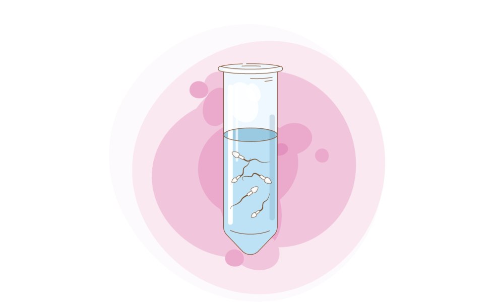 Extracorporeal fertilization drawing