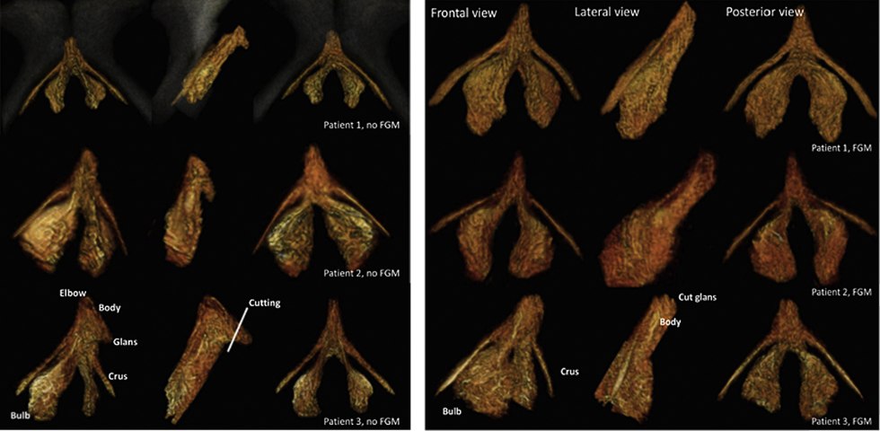 Freech hair in a boyfriend's boy