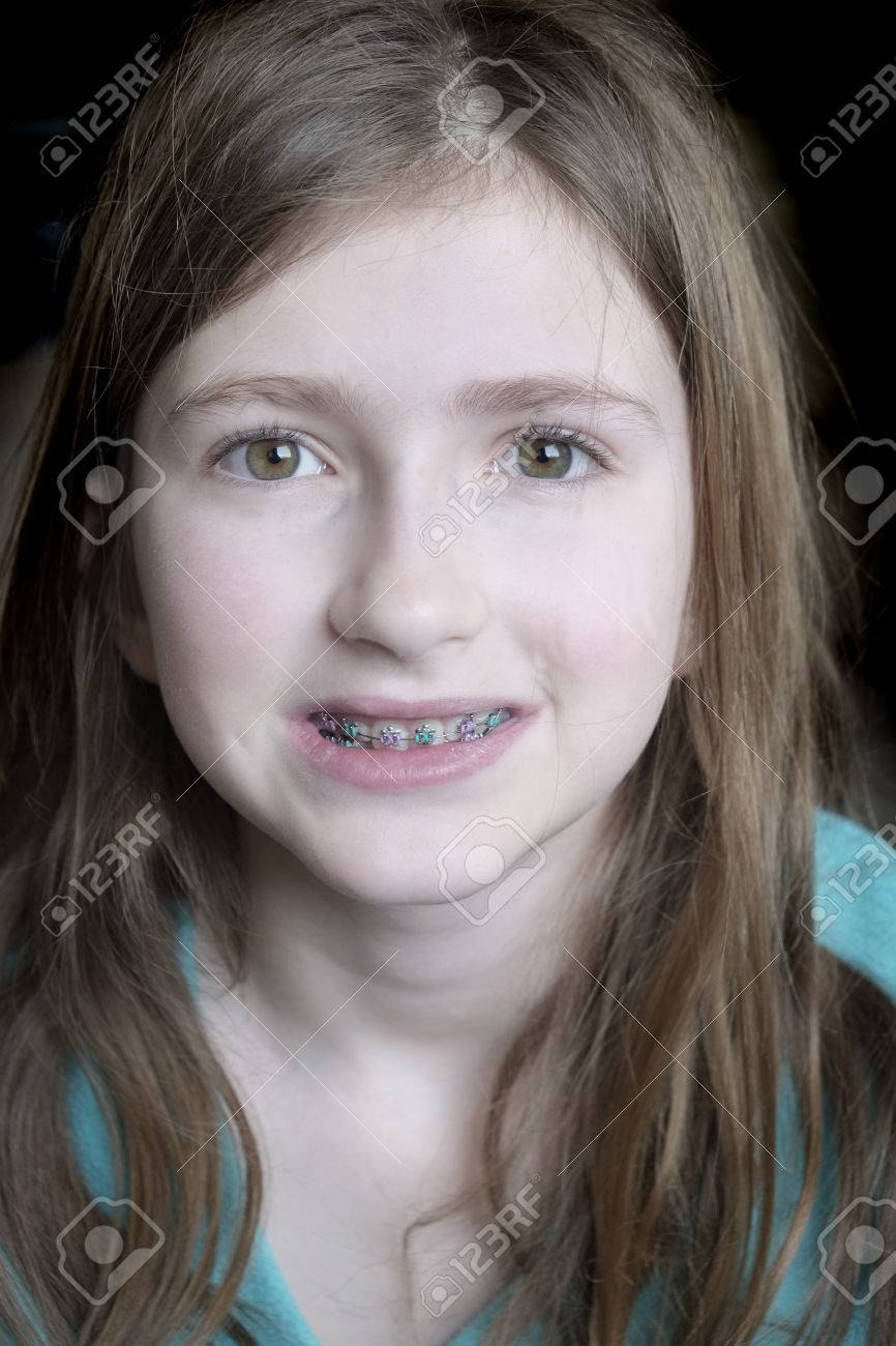 Artificial braces for beauty