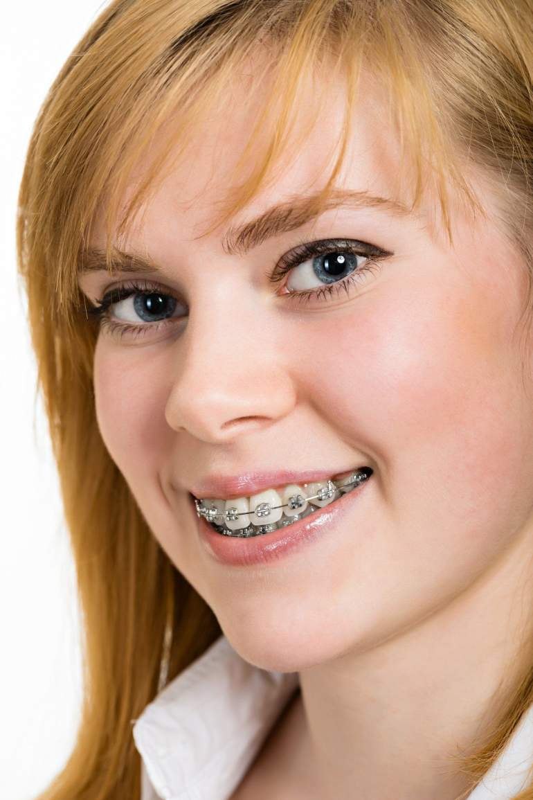 Incorrect braces hygiene