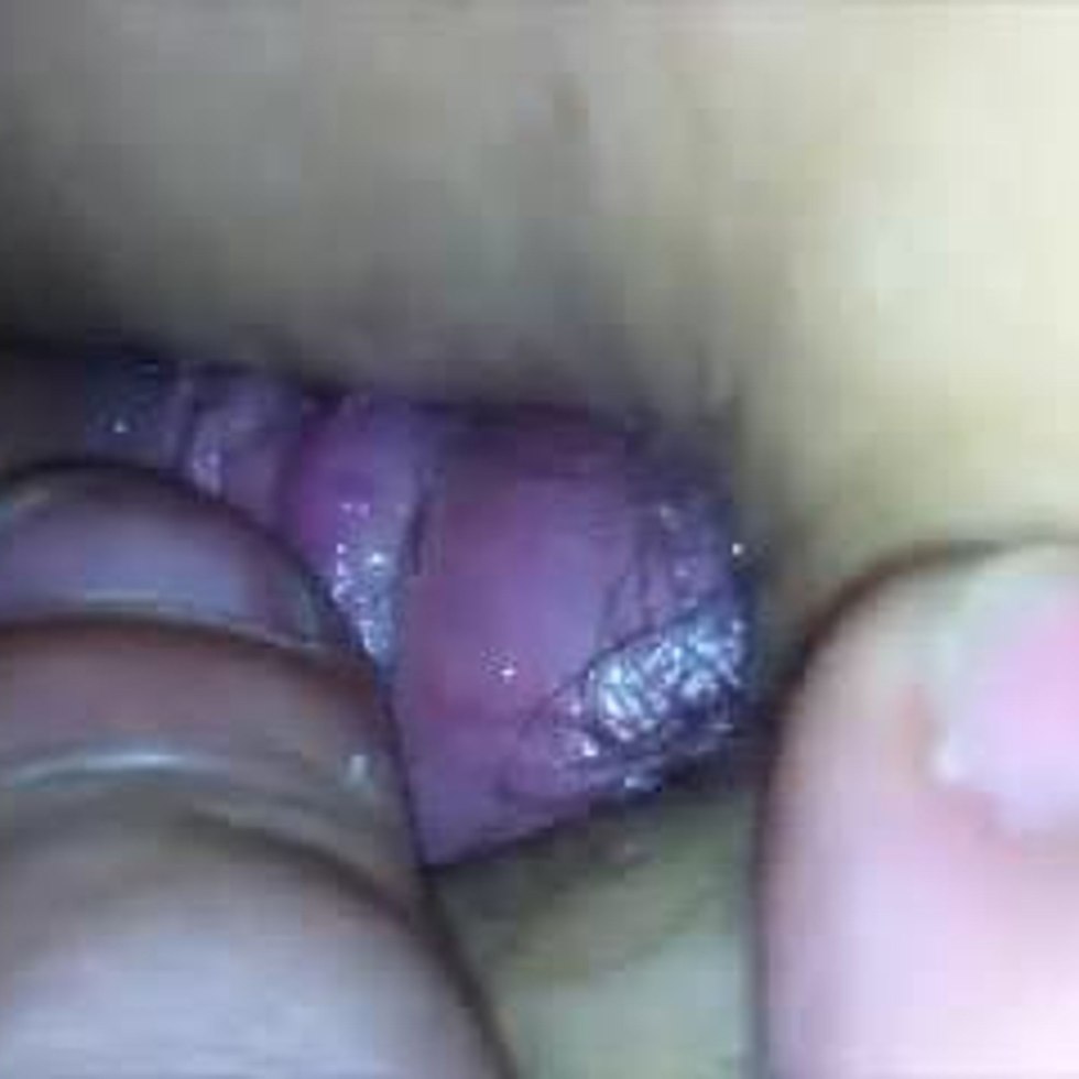 Vagina after a vacuum pump