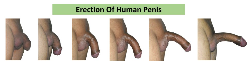 Non -sector penis