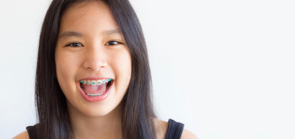 Girls with transparent braces