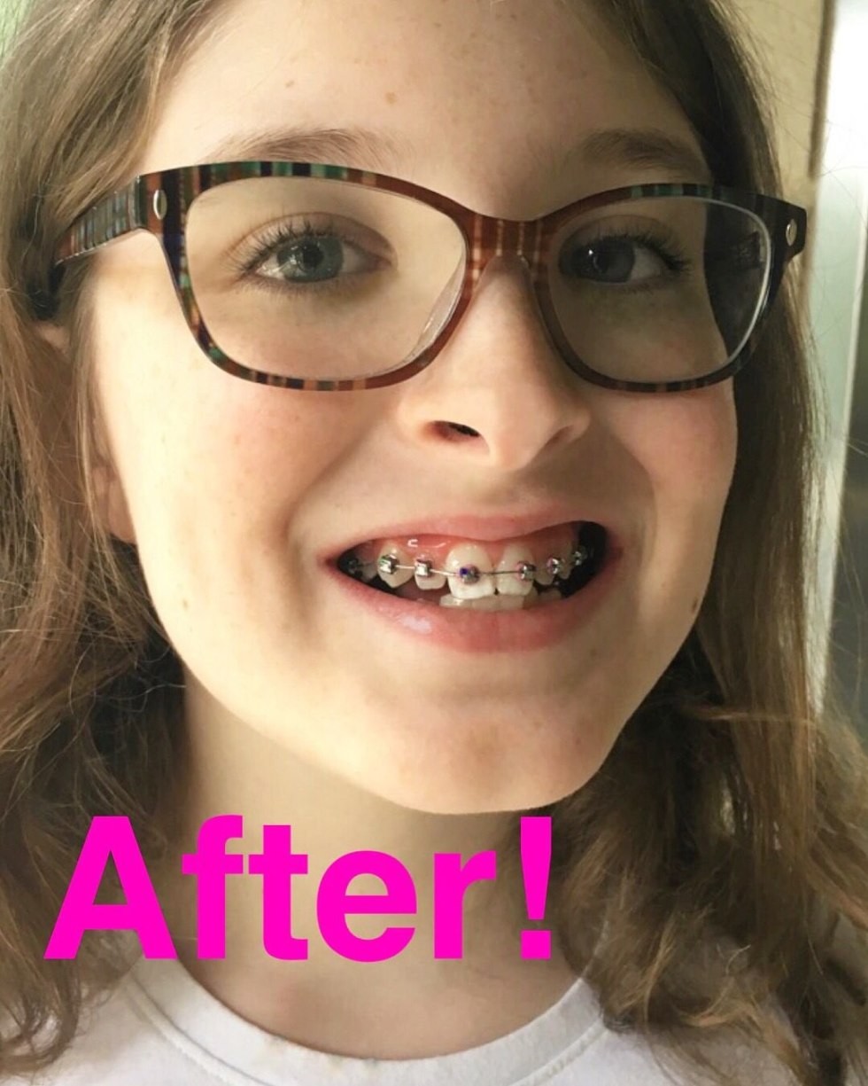 Young girl with an open mouth Brace