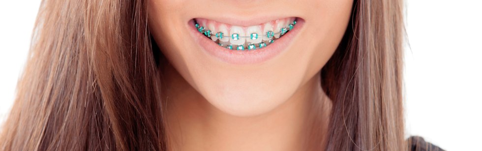 Ceramic braces