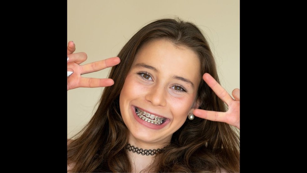 Allergies to metal braces