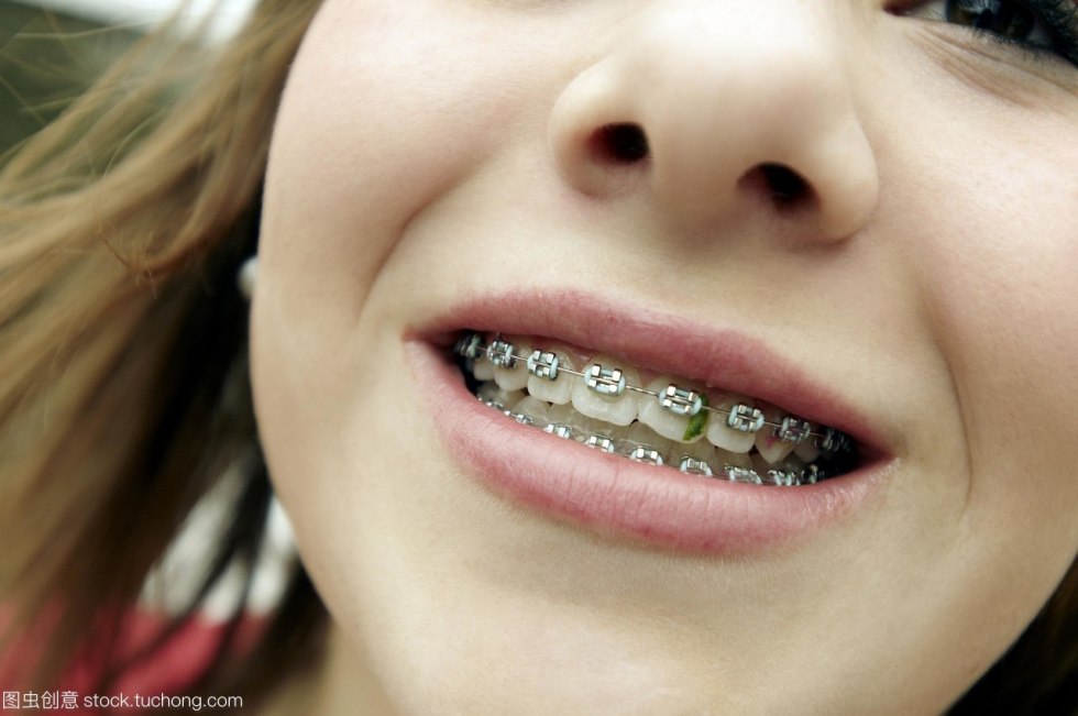Girl with braces