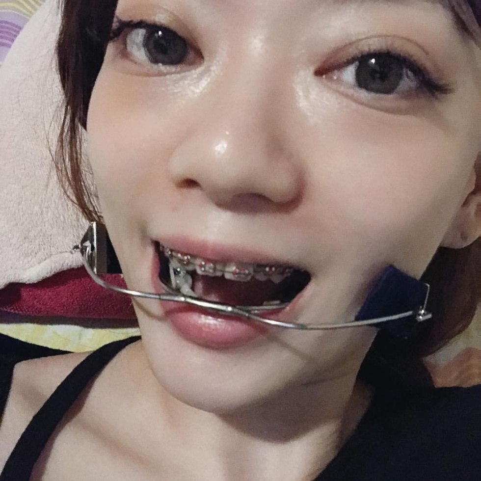 Beautiful braces