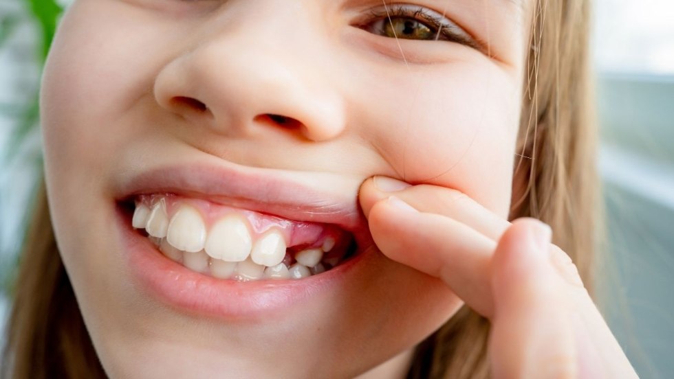 Two girls with braces