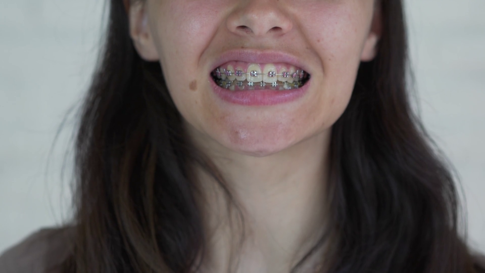 Bracies with elastic bands on girls