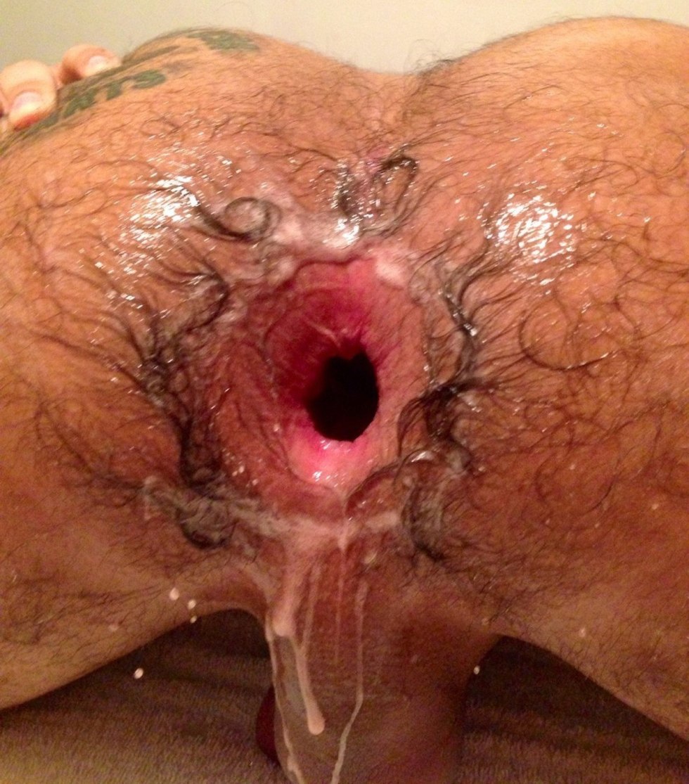 Blagless male anus