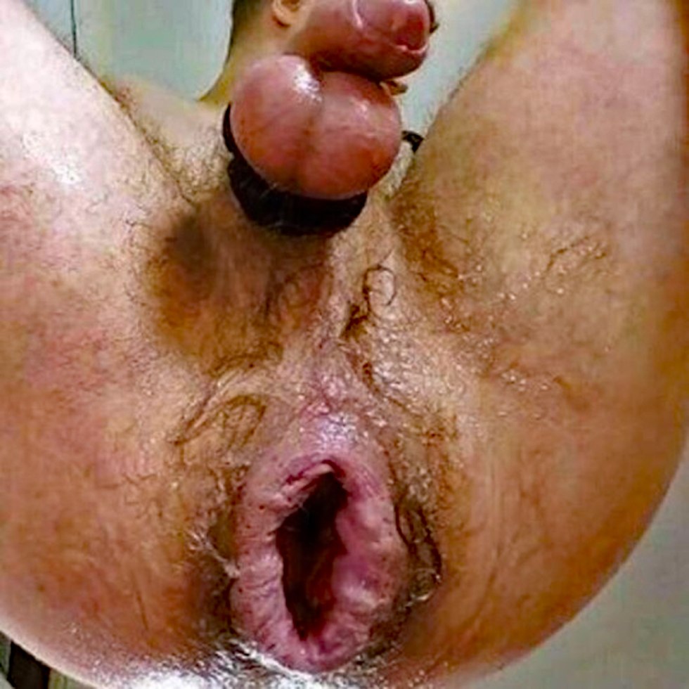 Blagless male anus