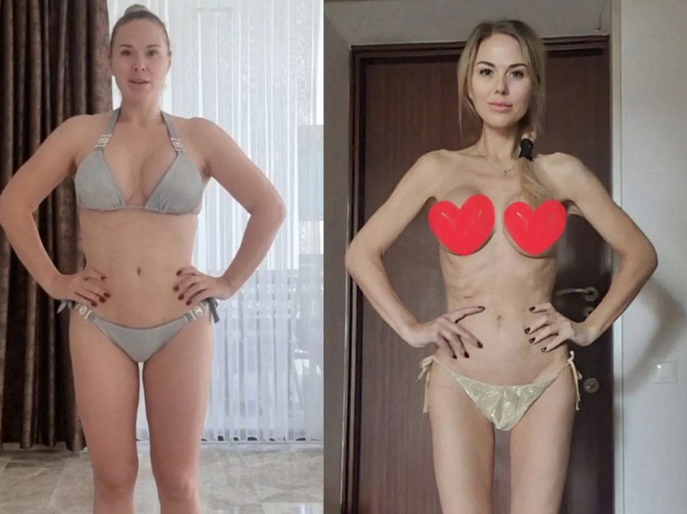 Masya Shpak anorexia