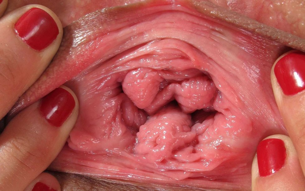 Close -up vaginal walls