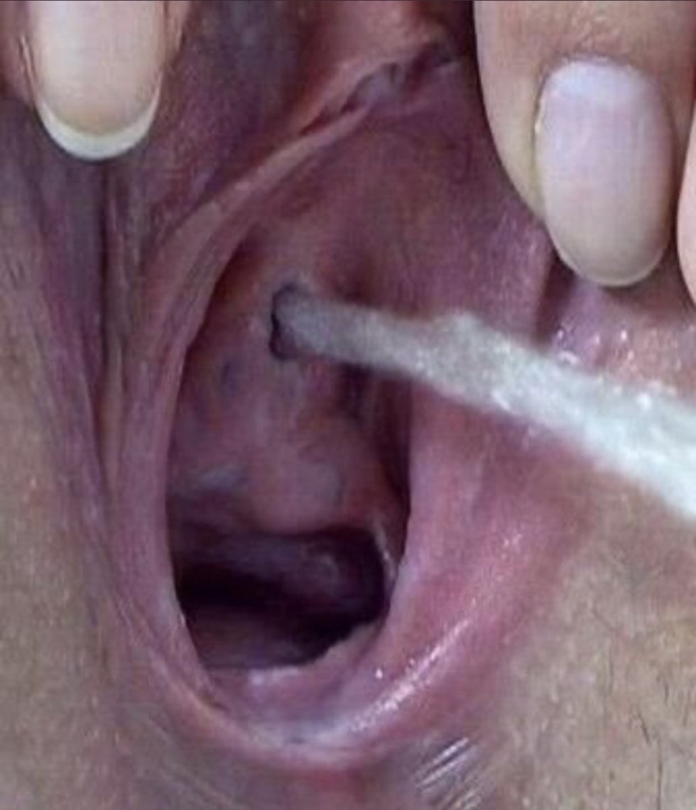 Women's urethra close -up