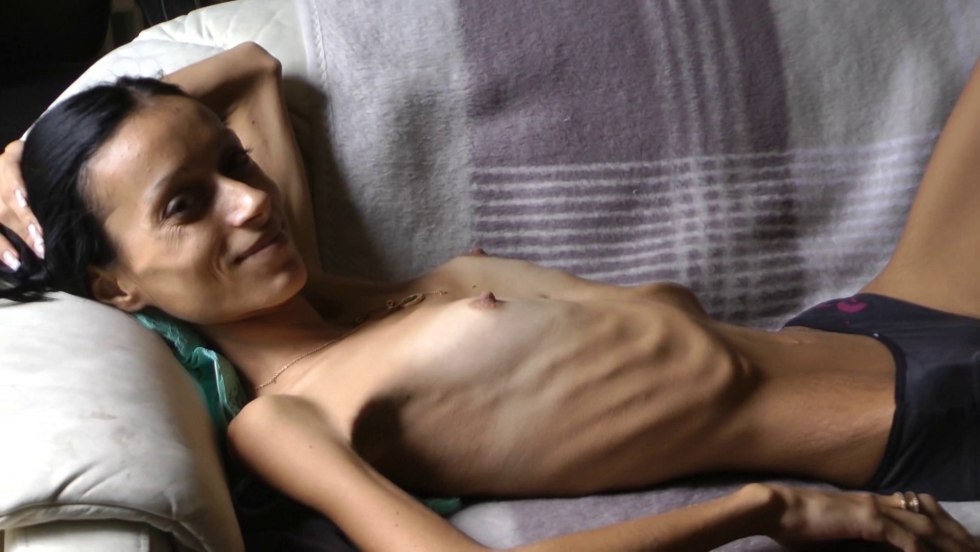 Tits of girls with anorexia