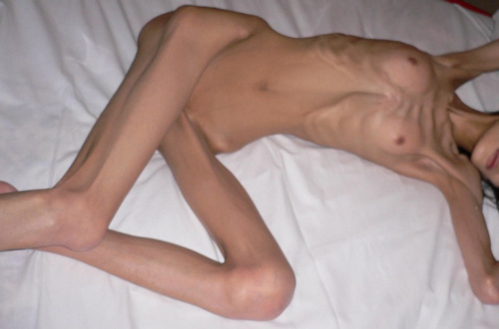 Woman Naked Skinny with AIDS