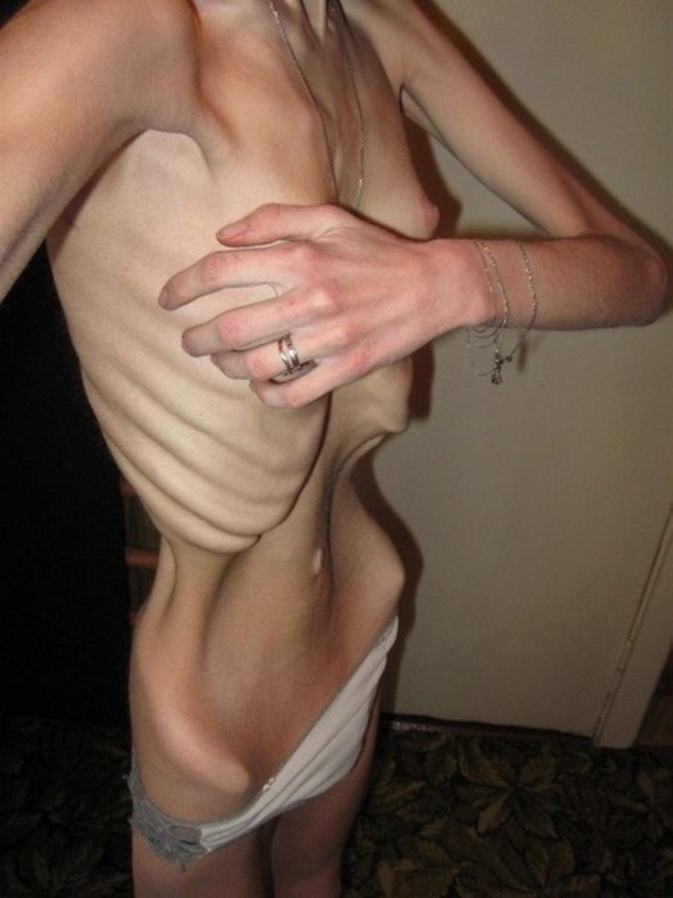 Naked women with anorexia