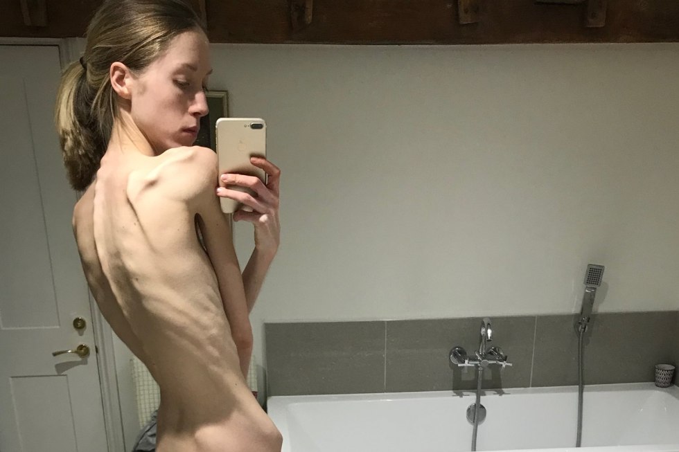 Naked young girls anorexics