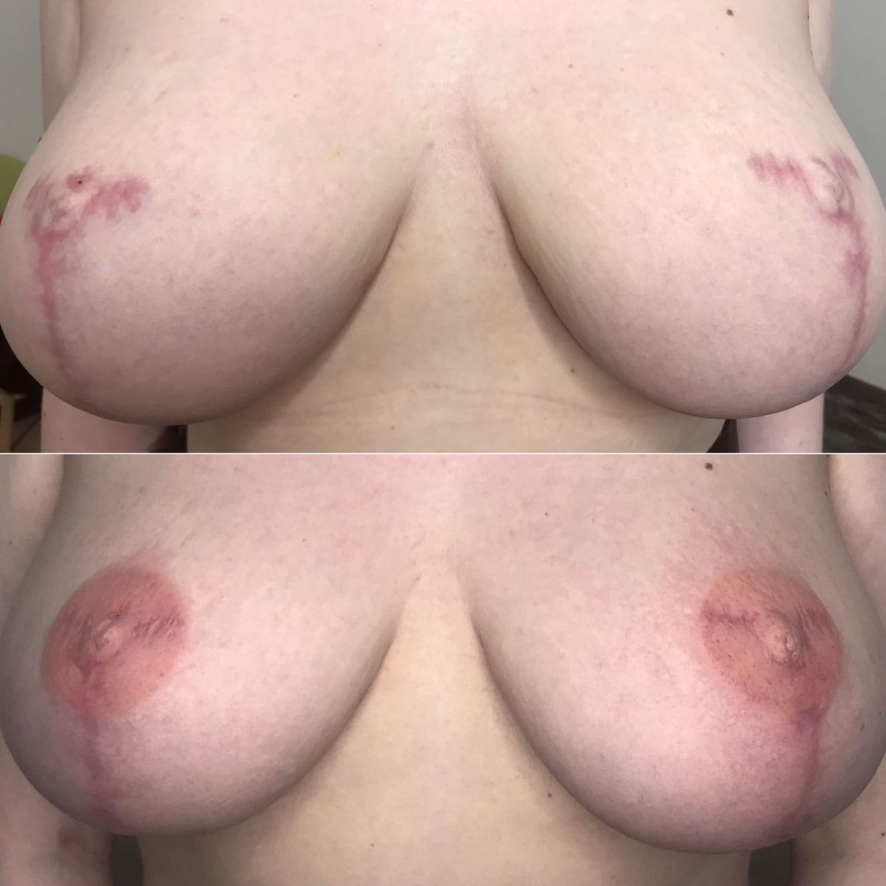 Permanent makeup of the areola of the chest