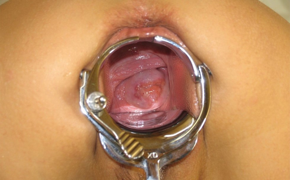Gynecological expander in vagina