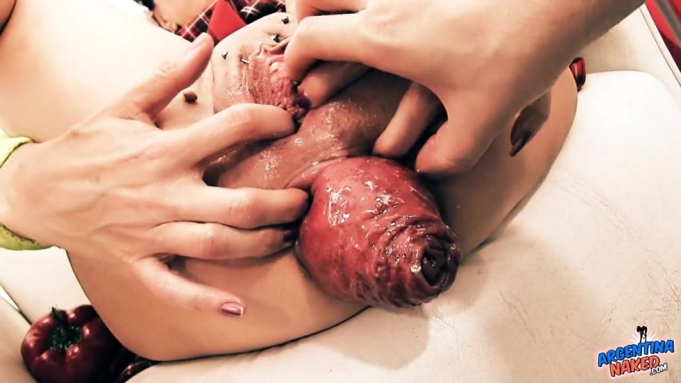 Giant prolapse of the uterus