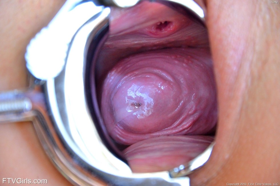 Cervix of the uterus of close -up ends