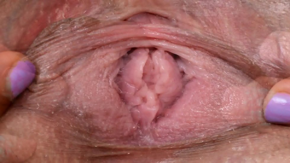 Conadilomas inside the vagina