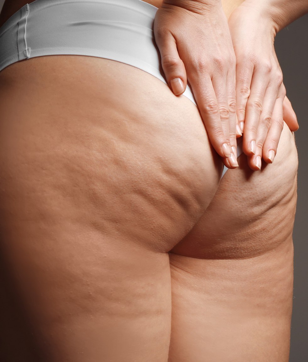 Cellulite buttocks