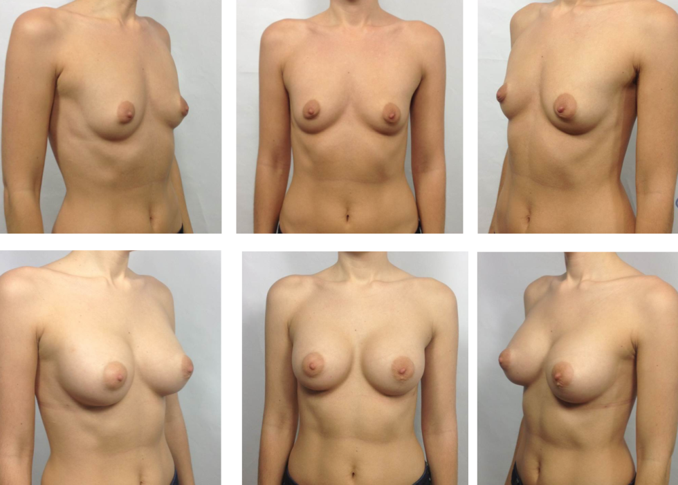 Naked boobs of various shapes