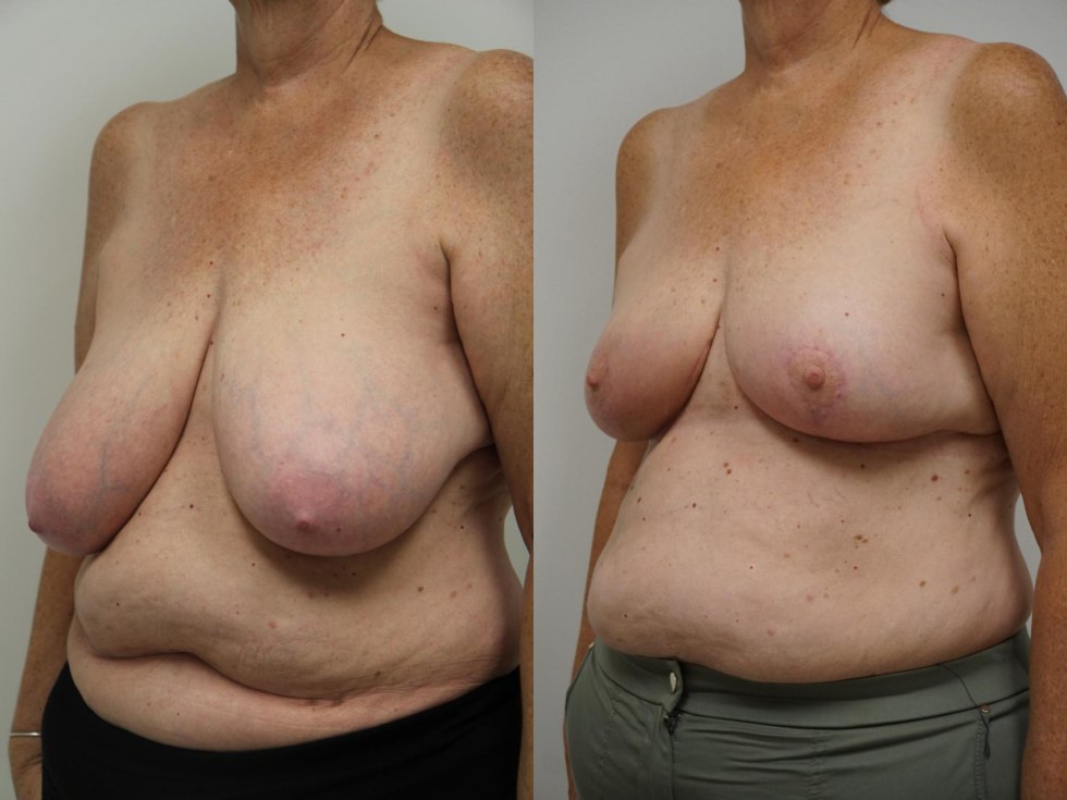 Macromastia Breasts Reduction Before AFTER