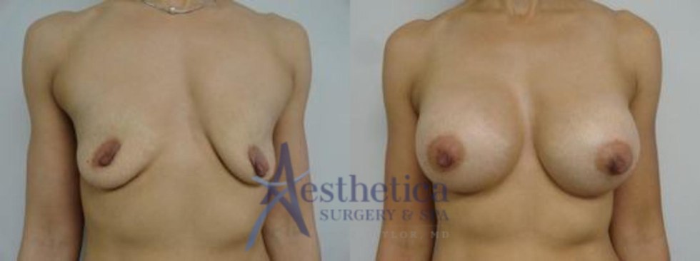 Areolar chest tightening