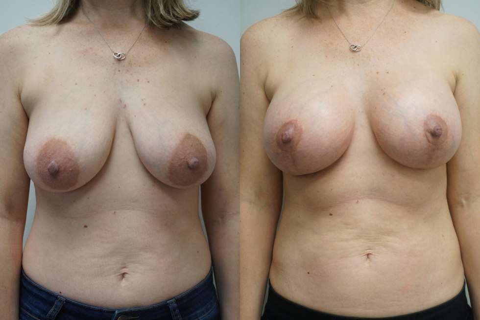 Breast Plastic Surgery Before AFTER Tubular breasts of selfies