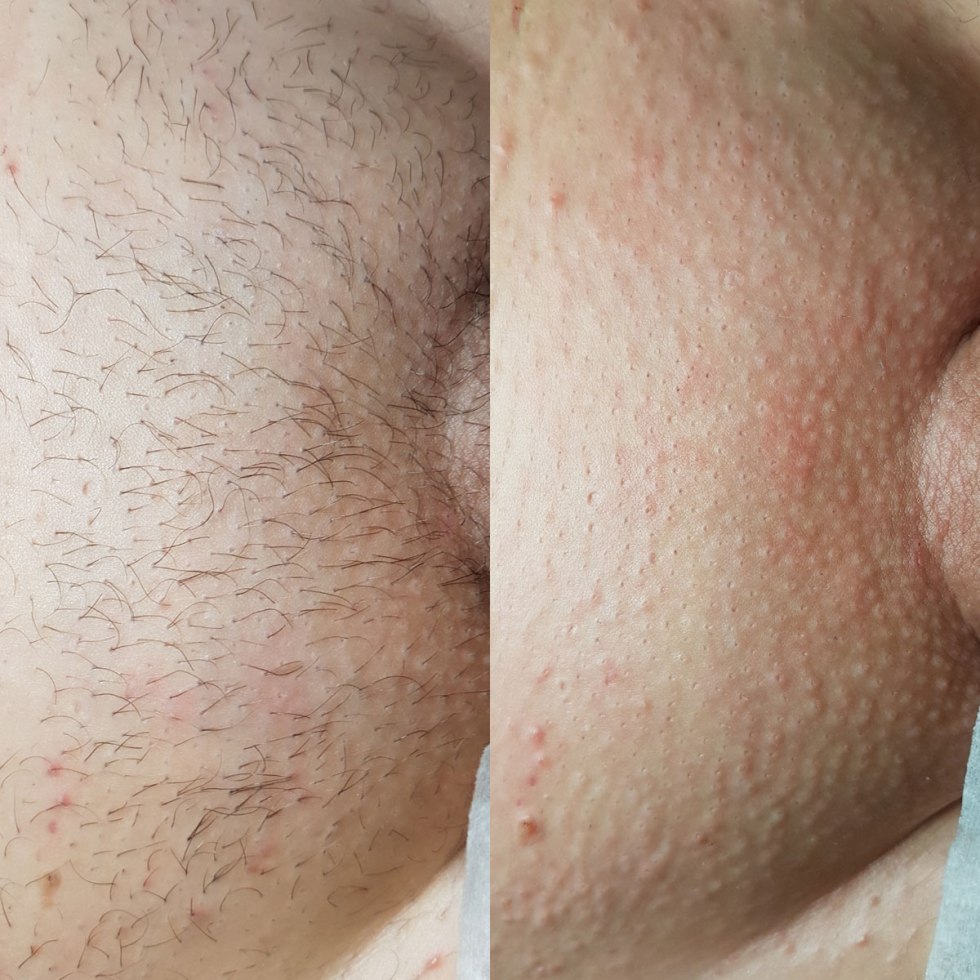 Men's pubic hair removal