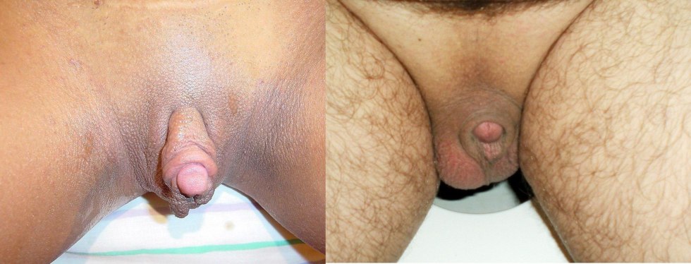Unusual genitals