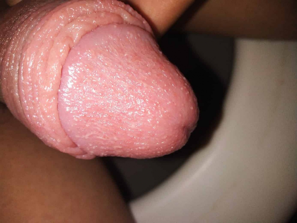Hyperemia of the head of the penis