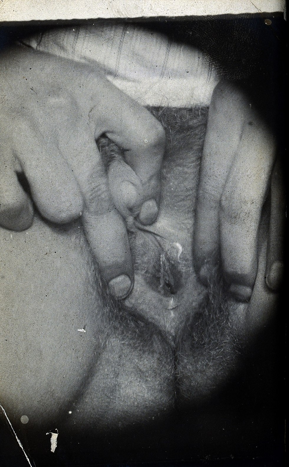 Gerphroditis genital organs