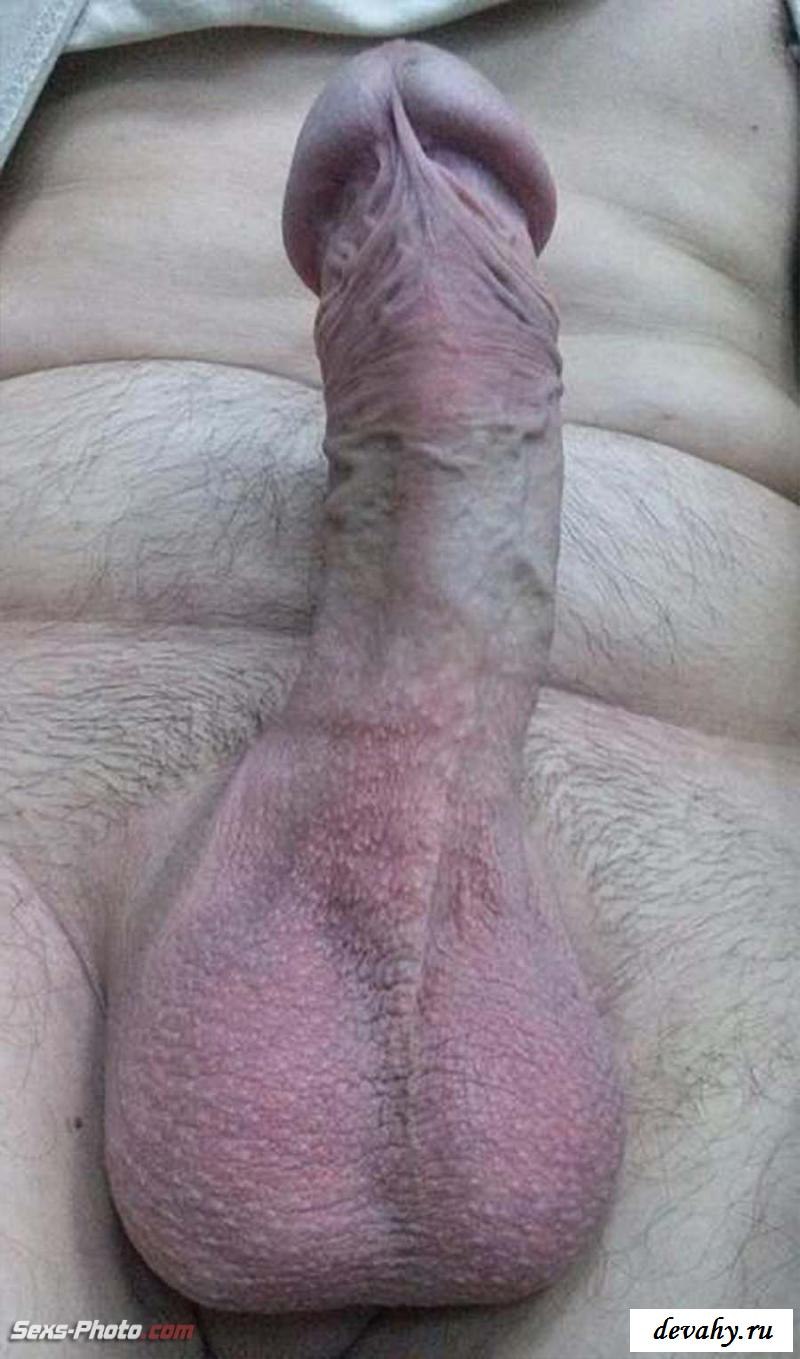 Glandular hypospadia