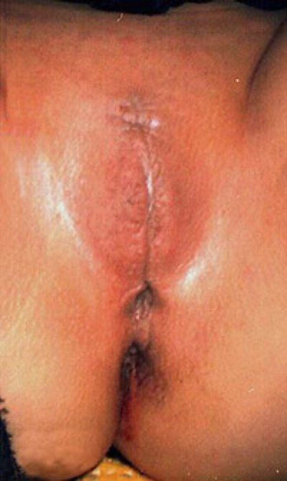 Women's circumcision vagina