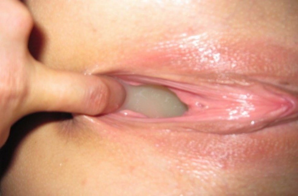 Vaginal discharge closeup