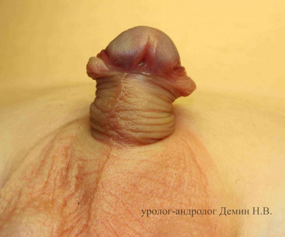 Glandular hypospadia