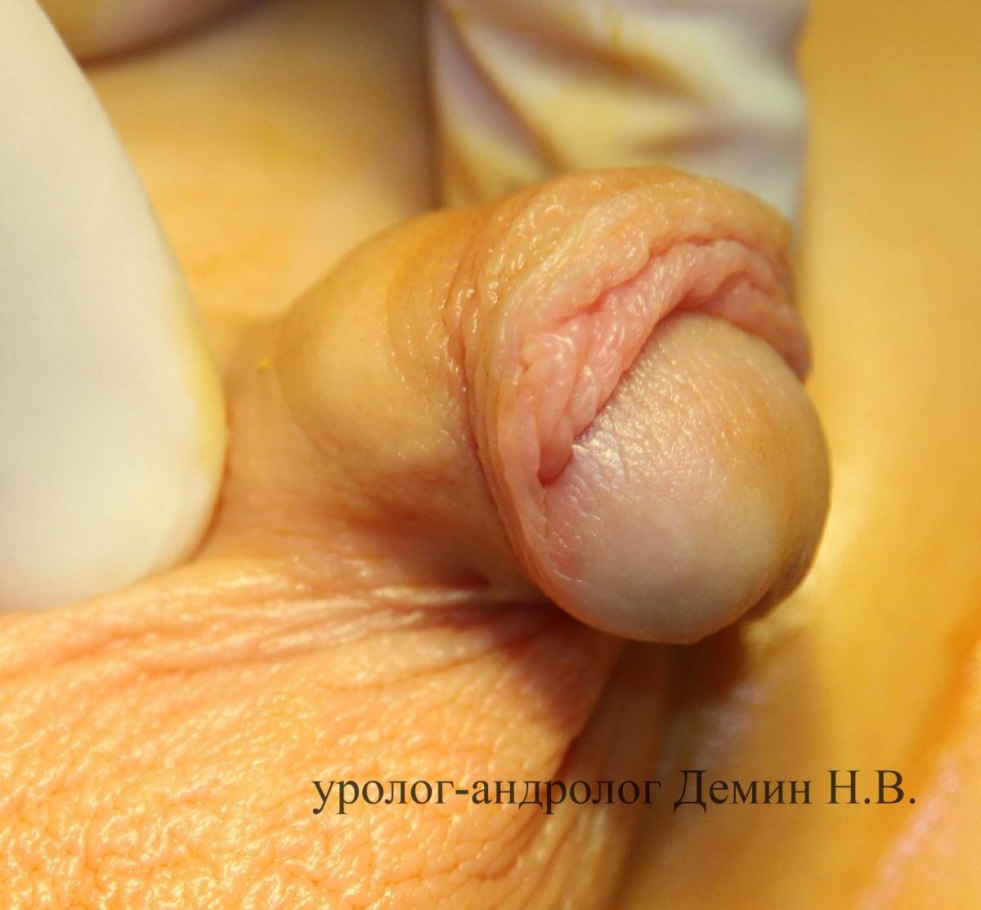 Hypospadia Penis Boy