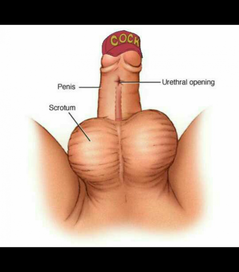 Microsenis, Hypospadia