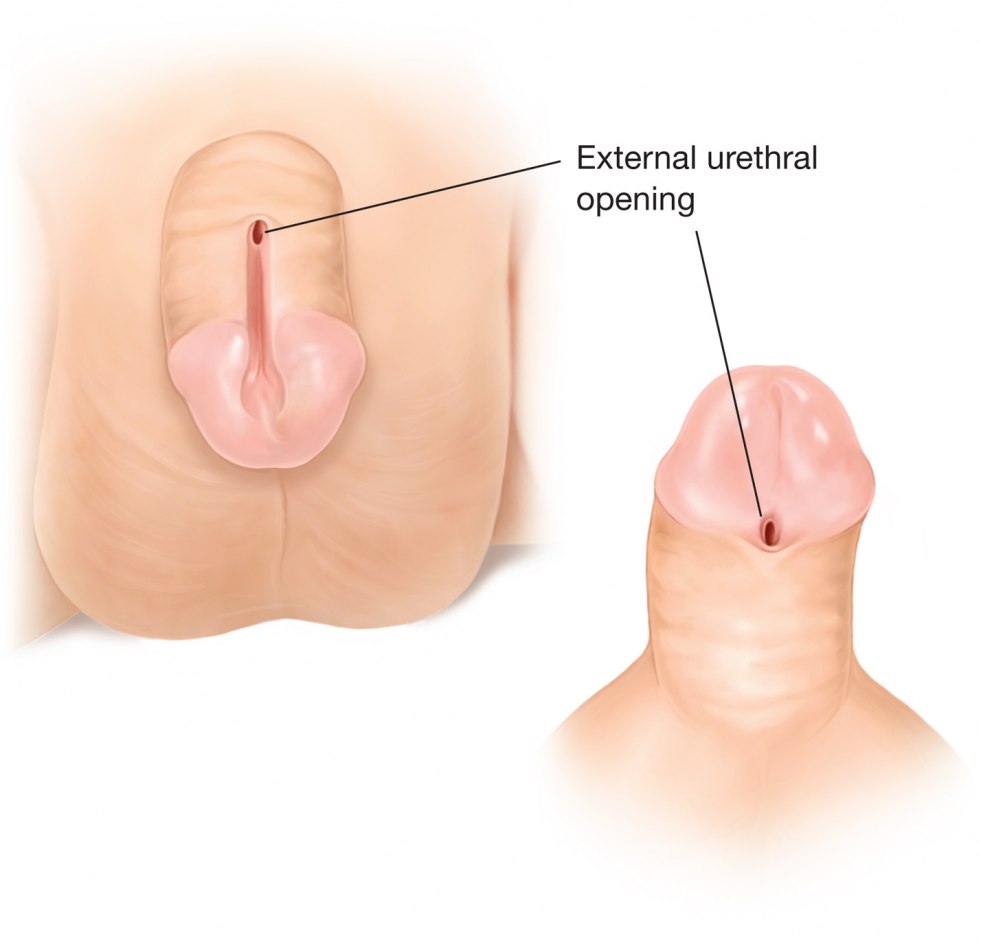 Hypospadia extreme flesh