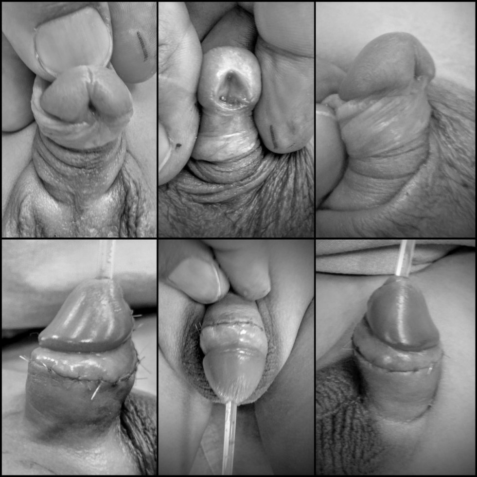 Member after Operation Hypospadia Vernoy