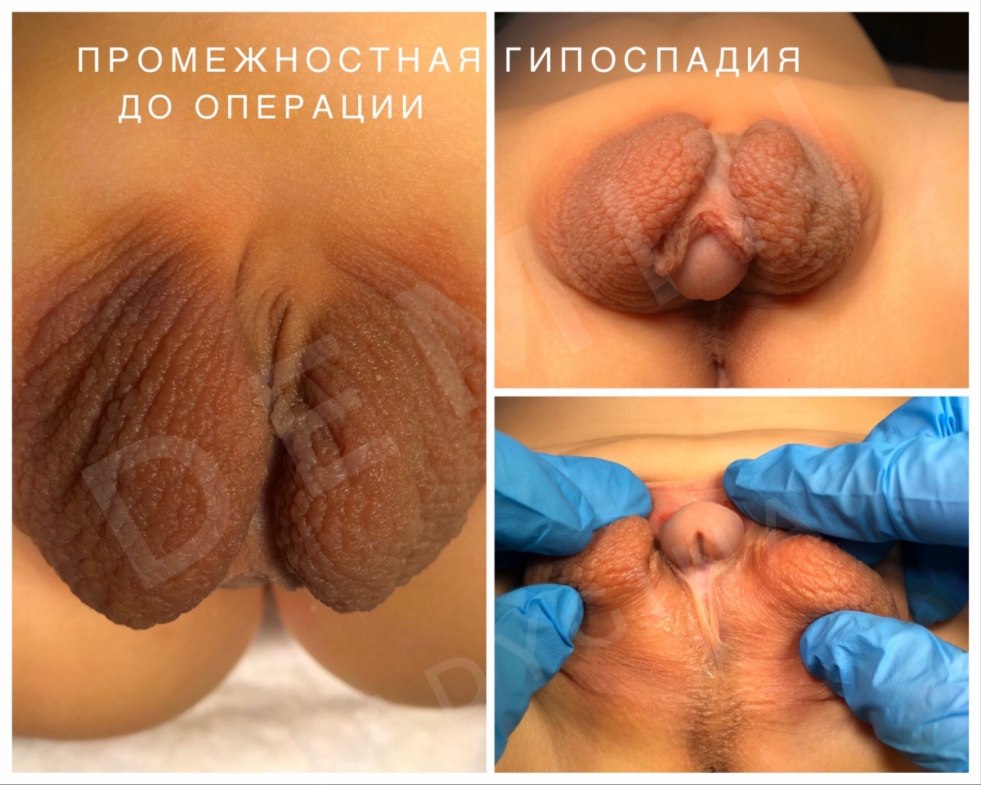 Abnormal female genitals